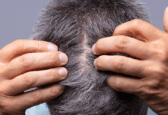 férfi haj korpásodás