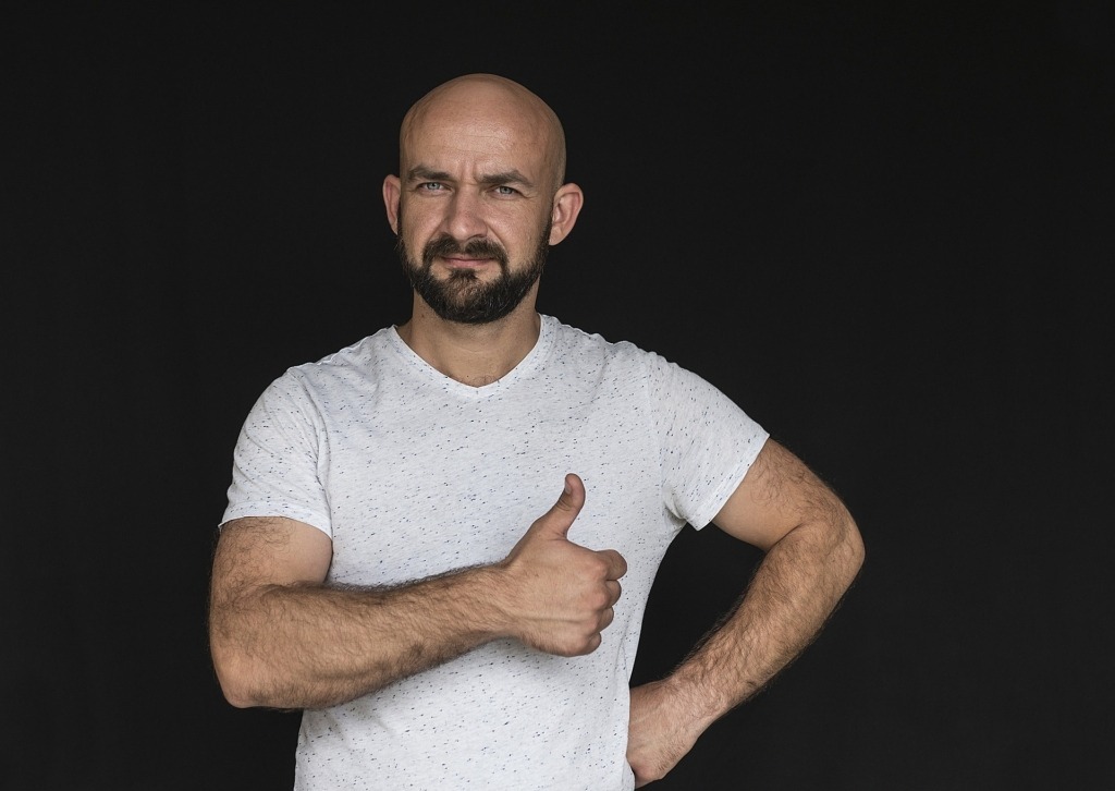 A férfi kopaszodás 7 stádiuma