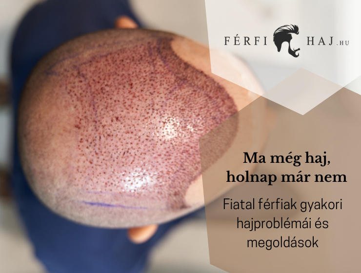 fiatal férfi hajproblémák